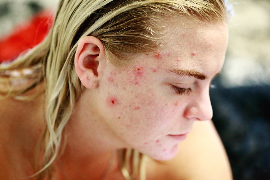 How to Get Rid of Acne Naturally